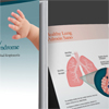 Ony Infasurf respiratory distress syndrome (RDS) informational brochure